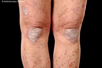 Overview Psoriasis 1. Epidemiology of psoriasis 2. Histology Dr Nigel Burrows Consultant Dermatologist Addenbrooke s Hospital Aug 2015 3. Types of psoriasis 4. Assessing severity 5.