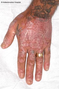 Summary Psoriasis is common (2%) Many different patterns and may look different at different body
