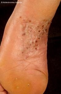 Guttate Psoriasis 2% of patients with psoriasis