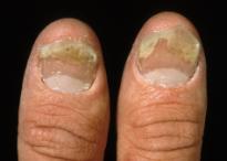 arthralgia but only 10% have true psoriatic arthritis 65% skin precedes joints 5 patterns DIPJ + associated nail changes