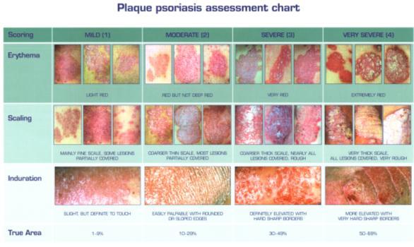 Measuring the severity of psoriasis PASI & DLQI scoring