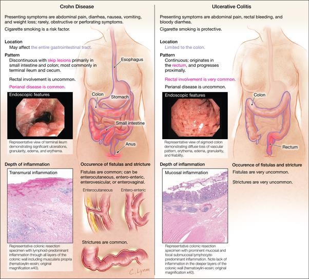 Figure 5: differences between CD and UC Clinical presentation and laboratory findings Differentiation between UC and CD is based on signs and symptoms
