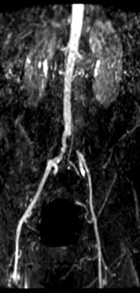 Magnetic Resonance Angiography (MRA) MRA has virtually replaced contrast arteriography for PAD diagnosis in some areas of the US Excellent arterial picture No ionizing radiation Noniodine based