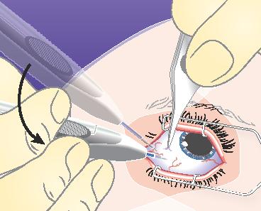 2) Allow the applicator to meet the sclera at an oblique angle with the bevel of the needle facing up, away from the sclera.