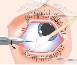 5) Withdraw the applicator in the same direction that you used to enter the vitreous. 6) Dispose of the applicator safely immediately after treatment. The OZURDEX applicator is for single use only.