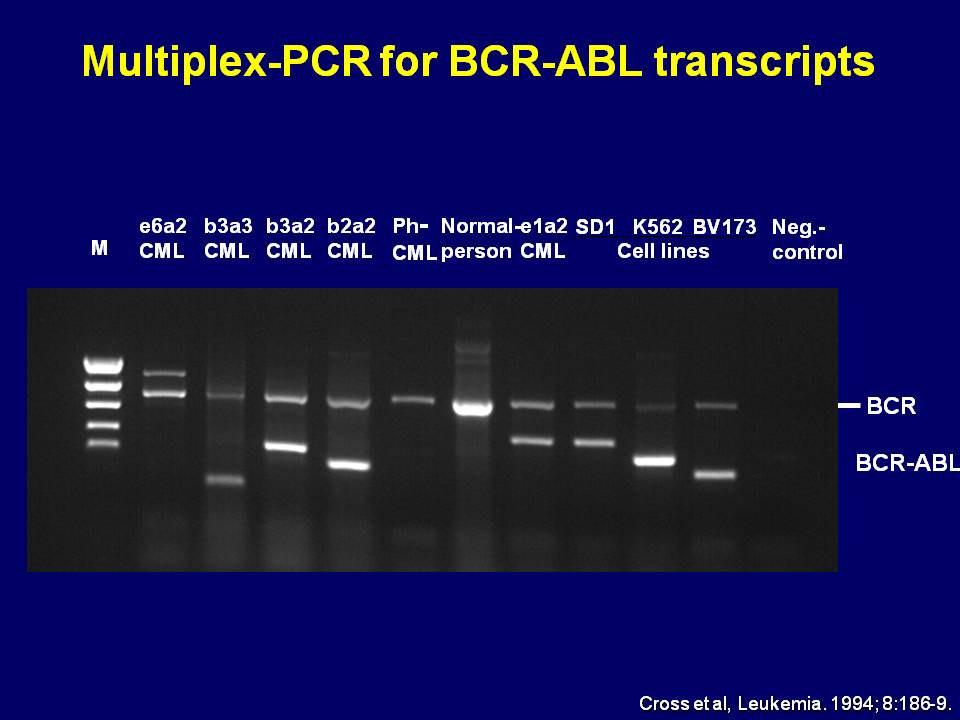 Ph chromosome and BCR-ABL1 gene BCR-ABL1: types of transcripts 9 9 q+ Chromosome 22 Chromosome 9 1a BCR ABL1 m-bcr 55 kd 1b 22 Ph(or 22q-) P21 BCR-ABL1 M-bcr 2,9 kb a2 a3 P19 BCR-ABL1 ABL1 BCR