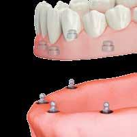 the need for maintenance; - 3 different gingival heights; - 3 different O-ring resistances