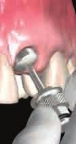 for abutment preparation and provisionalization During implant