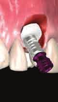 appropriate clearance Detach the abutment with the 1.
