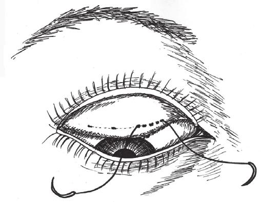 Serial illustration of the double-eyelid blepharoplasty (A) The lid is everted, and one end of the suture is inserted at the conjunctiva corresponding to the medial skin incision and passed