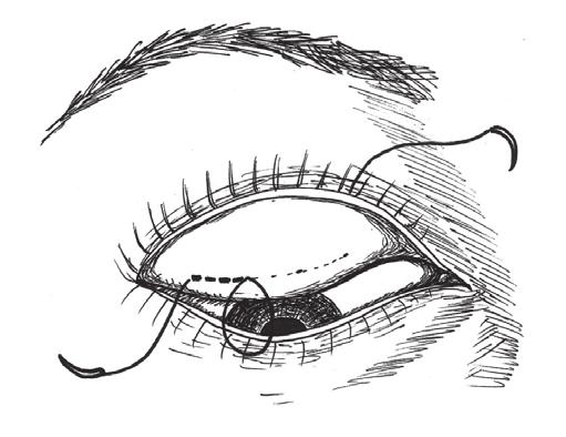 (B) Through the same points (conjunctival opening), each arm of the suture is passed through the lid and exits the skin through the second stab incisions.