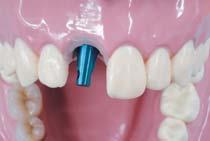 When applying a hex type abutment by using an abutment selector, you can choose an appropriate abutment in the lab or clinic.