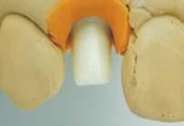 1~1.5mm you can fabricate a screw retained type prosthesis using zirconia