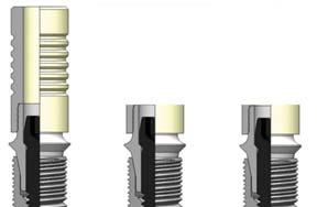 A prosthesis can be fabricated 4mm space from the fixture level with the GoldCast abutment.