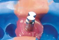 Inject impression material around the hole of the upper part of the coping and loosen the guide pin after the