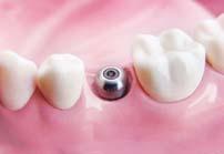 Screw retained restoration Convertible abutment Step4 Protect cap connection and temporary prosthesis fabrication Convertible