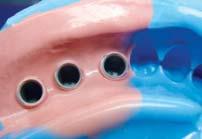 connect. Do not forget to use an abutment height of 4/5.5/7 mm and exclusive impression coping.