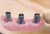 Apply separator around the analog and replicate the gingival area with exclusive material.