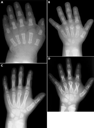 204 Letter Figure 3 Radiographs of the left hand. (A) Patient 4 aged 4 months.