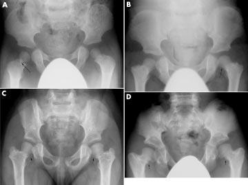 Letter 205 Figure 4 Radiographs of the pelvis. (A) Patient 3 aged 22 months. The pelvis is characterised by short and flared iliac wings.