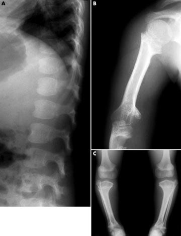 206 Letter Figure 5 Radiographs of the spine and upper/lower limbs. (A) Patient 3 aged 3.5 years.