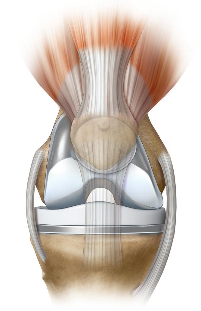Keeping Your Knee Healthy Understanding Knee Replacement Know the right moves and avoid the wrong ones. This will help keep your knee healthy.
