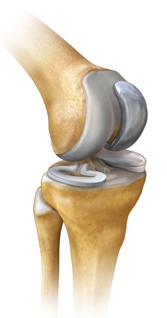 The joint is supported by muscles and ligaments. It s lined with a smooth tissue called cartilage. Sometimes the cushioning cartilage wears away. If it does, the knee becomes stiff and painful.
