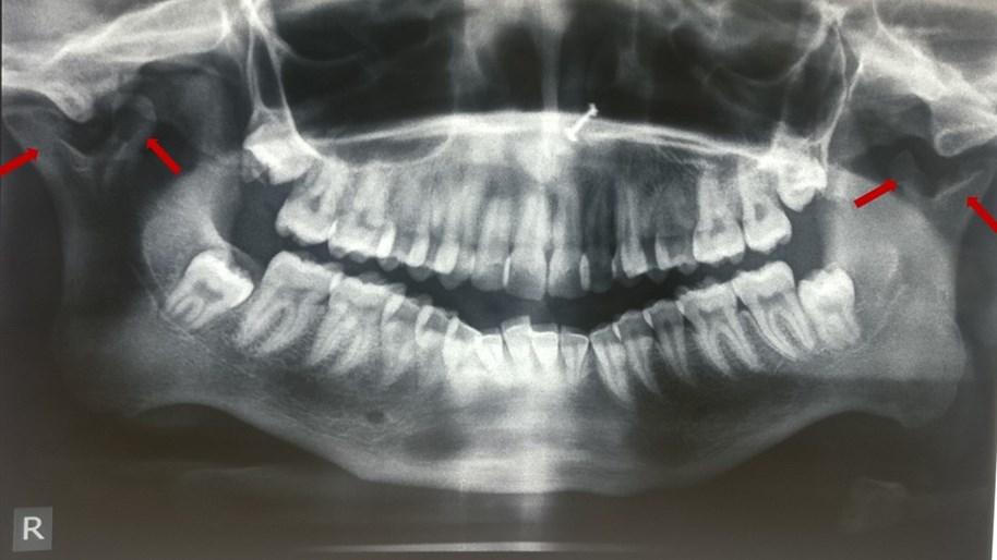 radiograph showing bilateral bifid condyle