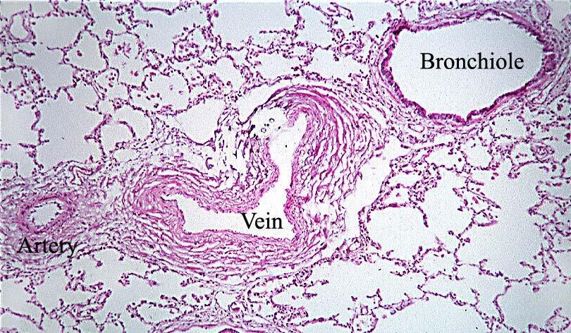 Classification of lung pathology Alveolar