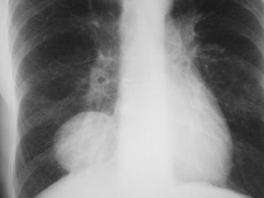 Well-Defined Calcification Ill-Defined Mass 27