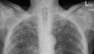 pattern Pleural effusions 37 Miliary TB Insidious in