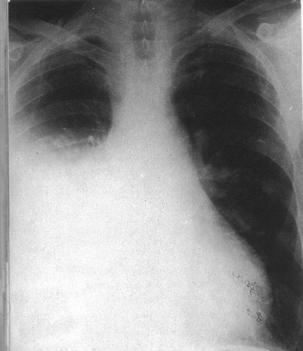 Pleural TB Peripheral