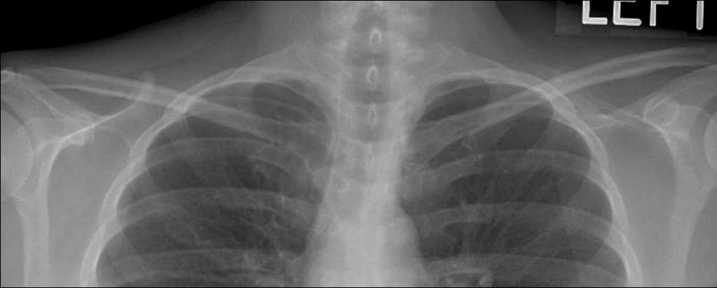 15 Causes of Poor Quality Chest X-Rays Over or under