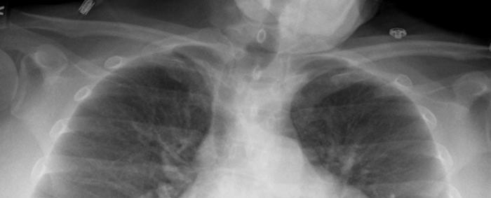 Angulation Scapula overlying lung fields Foreign