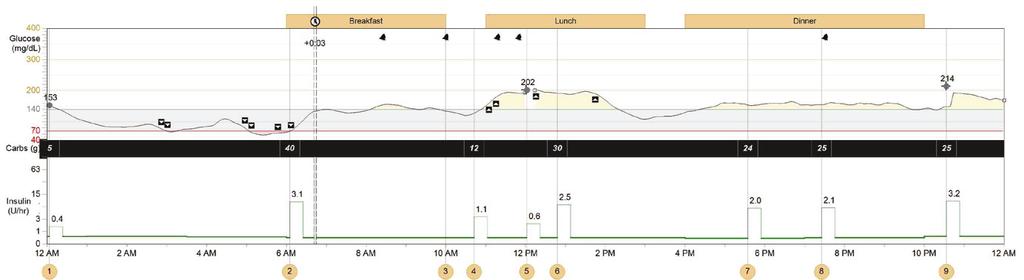 Daily Detail Report Displays pump, sensor, and blood glucose meter information from a specific day to provide insight on a patient s glucose control, including response to carbohydrate intake and