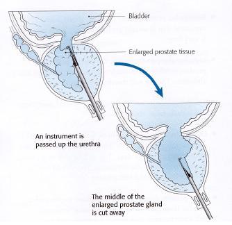 Reproduced by kind permission Health Press Ltd, Oxford What is a Transurethral Incision of the Prostate (TUIP)? This procedure is also known as a bladder neck incision.