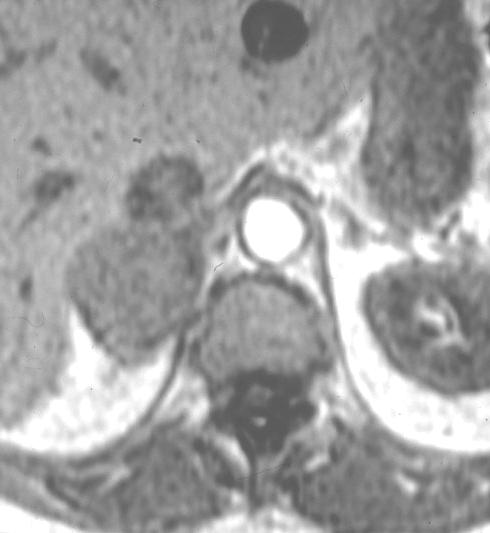 The premise with this technique is that most adenomas contain lipid and more than 80% are of the lipid-rich variety [11]. In general, malignant adrenal lesions do not contain lipid.