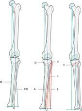 the varus knee correlates with KOOS MCID Why