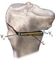 contralateral side MOWHTO Distal MCL