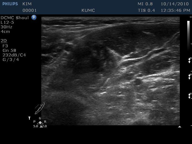 Sonography of median nerve( transverse)-upper forearm Upper 1/3 D s D s