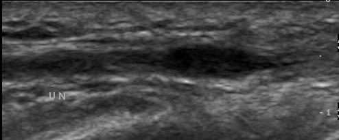 B) Ulnar nerve shows fusiform swelling(arrows)