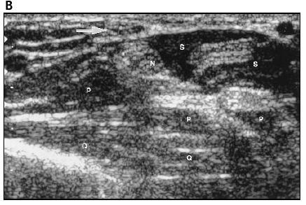 Sonography of median nerve(transverse) Median nerve foream level -distal forearm Corresponding to the middle