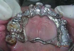 upper denture in patient mouth Maxillary arches were restored with removable partial overlay dentures.