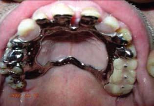 framework, and both restorations were tried in the patient mouth.