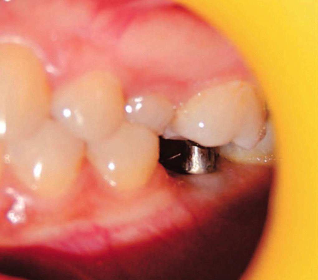 Since then implants have been used routinely to intrude molar without the need of an elaborate appliance and patience compliance.