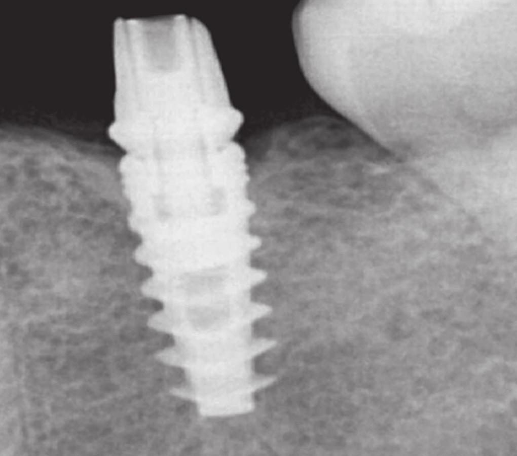 3X8 mm implants were employed as bone sounding on the palatal mucosa revealed a soft tissue thickness of 2 mm, and a minimum of 6mm of implant length should be engaged in the bone to achieve primary