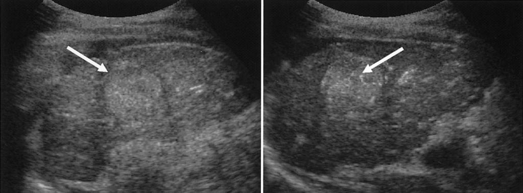 enhancement (typically 20 60 seconds after contrast injection), and during the delayed phase (5 minutes after a separate injection of contrast agent).