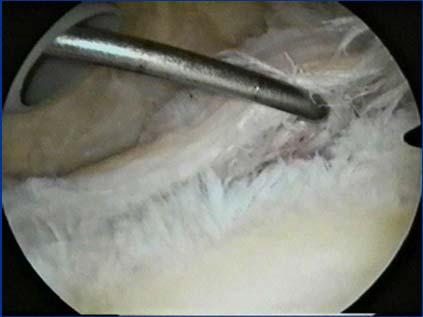 Current Solutions in Shoulder & Elbow Surgery Tampa, Florida February 9 12, 2017 Open Bankart: Why and How? Richard J.