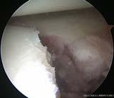 repairs Influential paper with two primary conclusions In contact athletes: Arthroscopic bankart repair in presence of bone loss = high failure rate Arthroscopic bankart repair in absence of