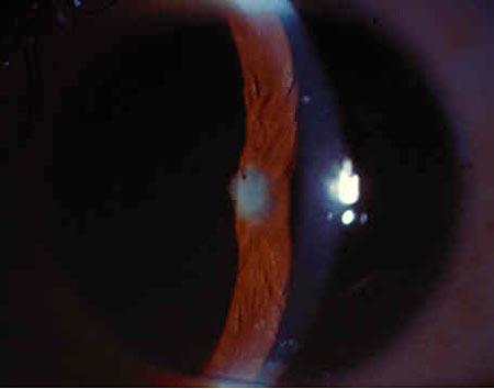 Glaucoma & Uveitis. Secondary Angle Closure. PAS.